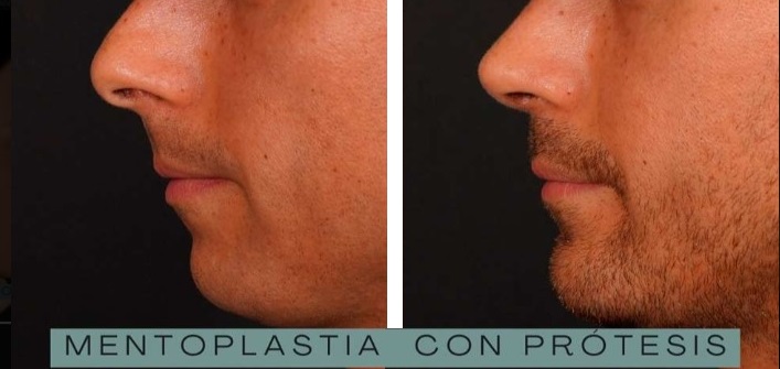 Mentoplastia caso 7 — antes y después